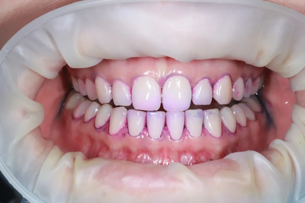 Видалення зубів