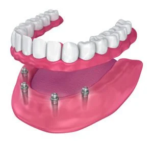 Kanye West Teeth Now: Permanent Status, Titanium Design, and Total Cost Breakdown